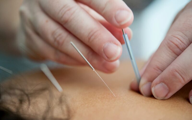 Beneficios de la acupuntura