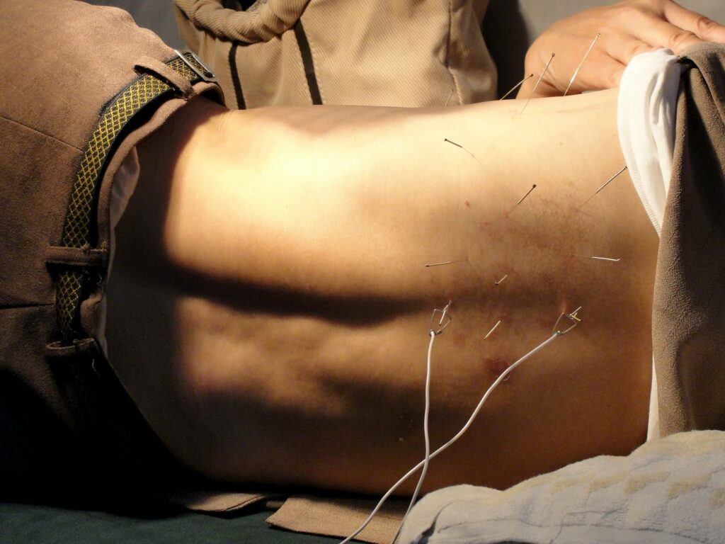 Hombre acupuntura en la espalda