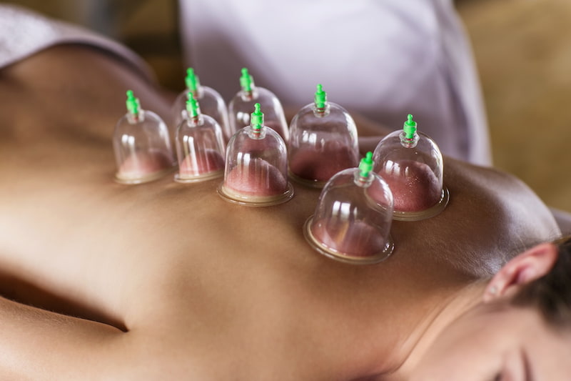 ¿Funciona el cupping?